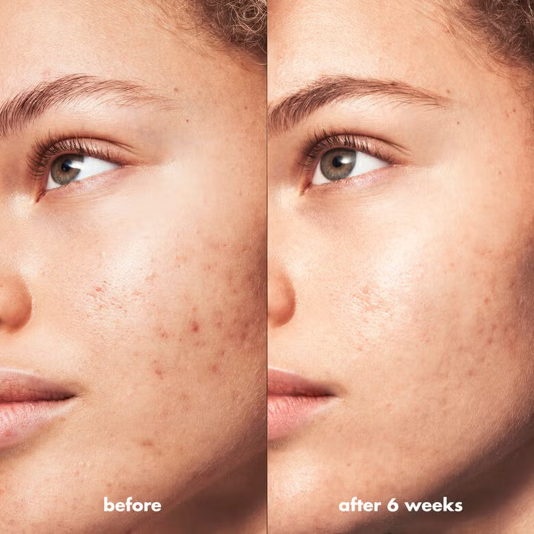 Blemish Breakthrough Blemish Control Basics Kit